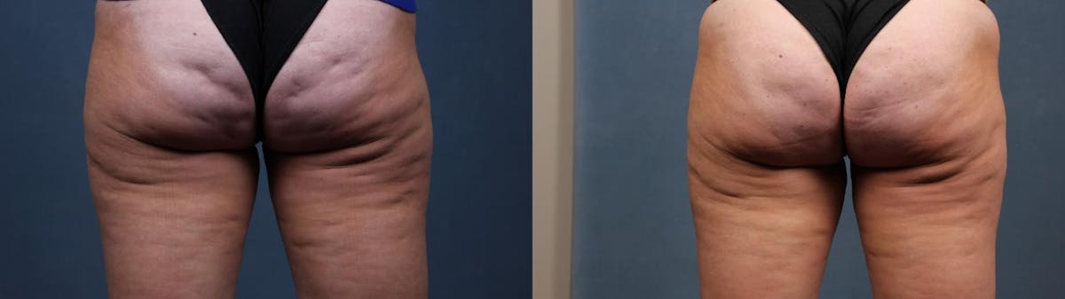 Cellulite Treatments Before & After Gallery - Patient 178684 - Image 1