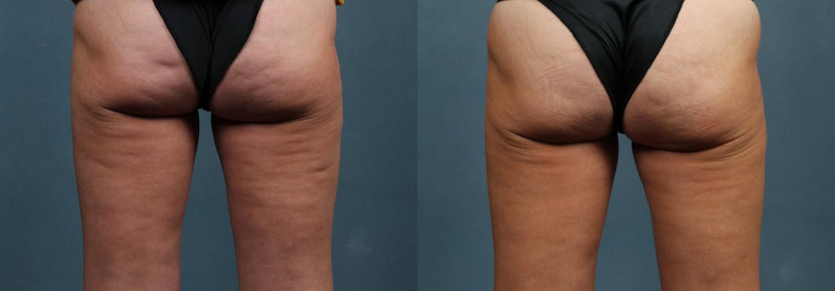 Cellulite Treatments Before & After Gallery - Patient 470048 - Image 1