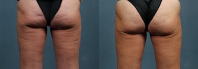 Cellulite Treatments Before & After Gallery - Patient 470048 - Image 1