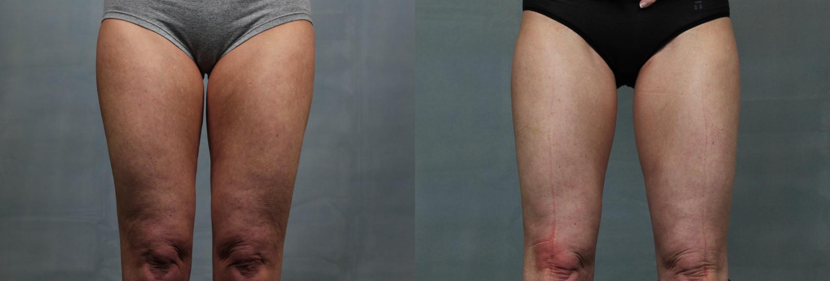 Patient 211327 | Cellulite Reduction Before & After Photos