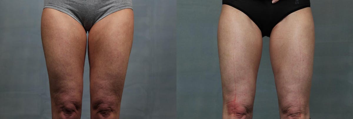 Cellulite Treatments Before & After Gallery - Patient 211327 - Image 1