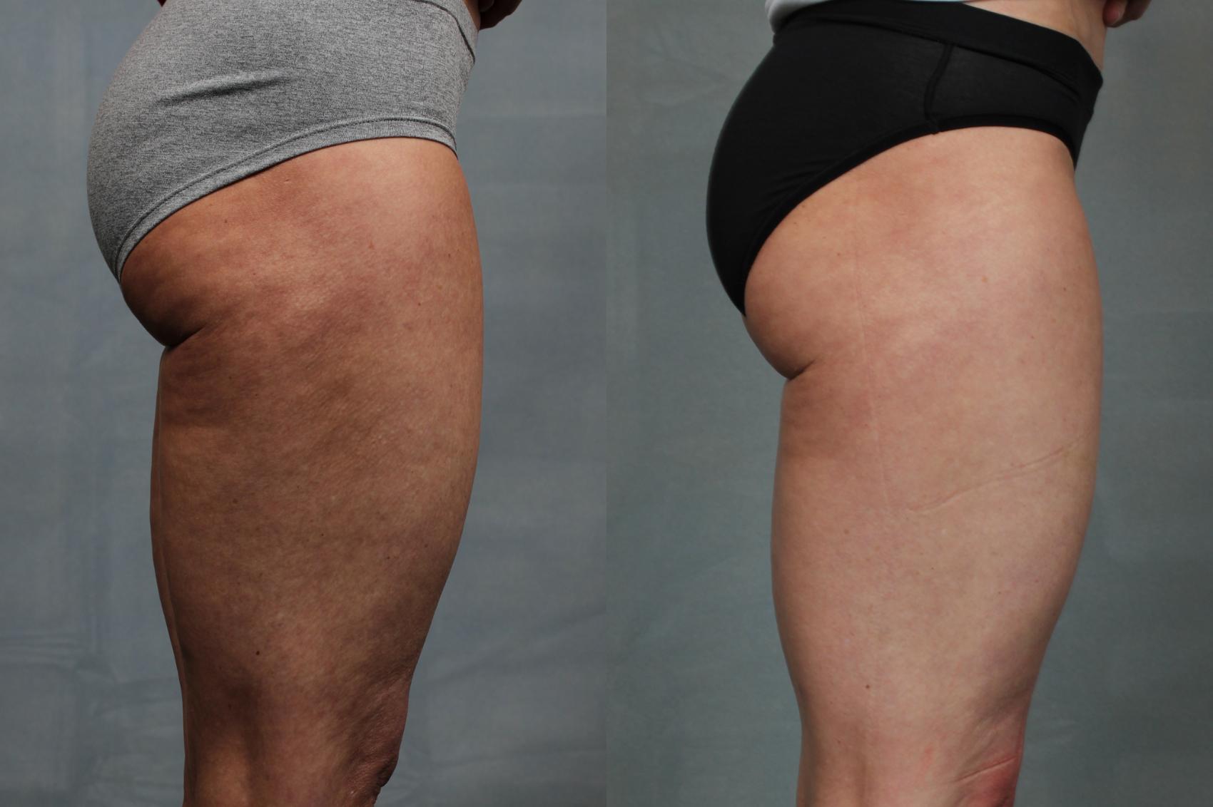 Patient 211327 | Cellulite Reduction Before & After Photos