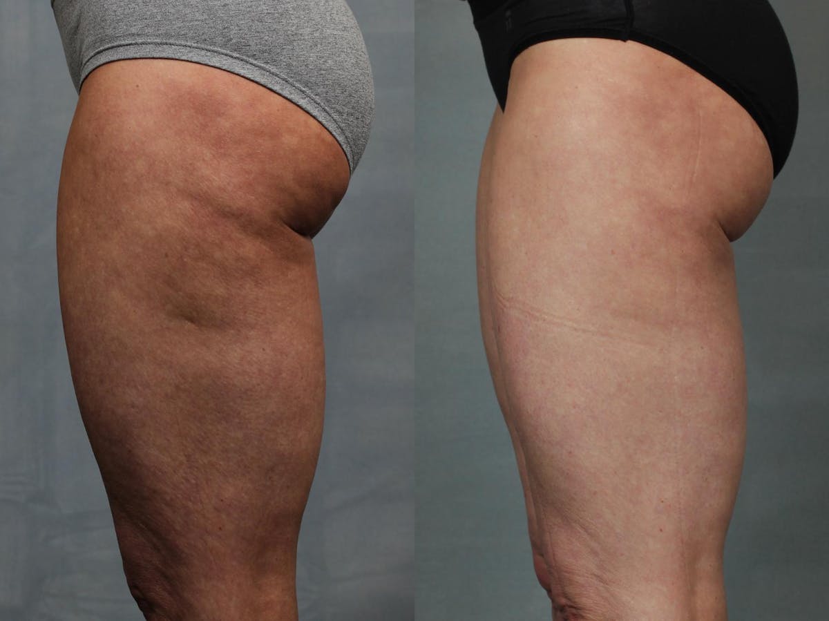 Cellulite Treatments Before & After Gallery - Patient 211327 - Image 3