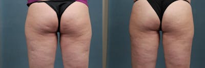 Cellulite Treatments Before & After Gallery - Patient 390418 - Image 1