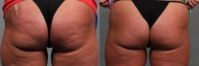 Cellulite Treatments Before & After Gallery - Patient 162277 - Image 1