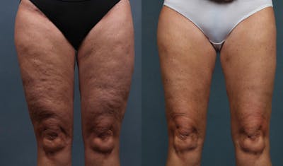 Cellulite Treatments Before & After Gallery - Patient 798136 - Image 1