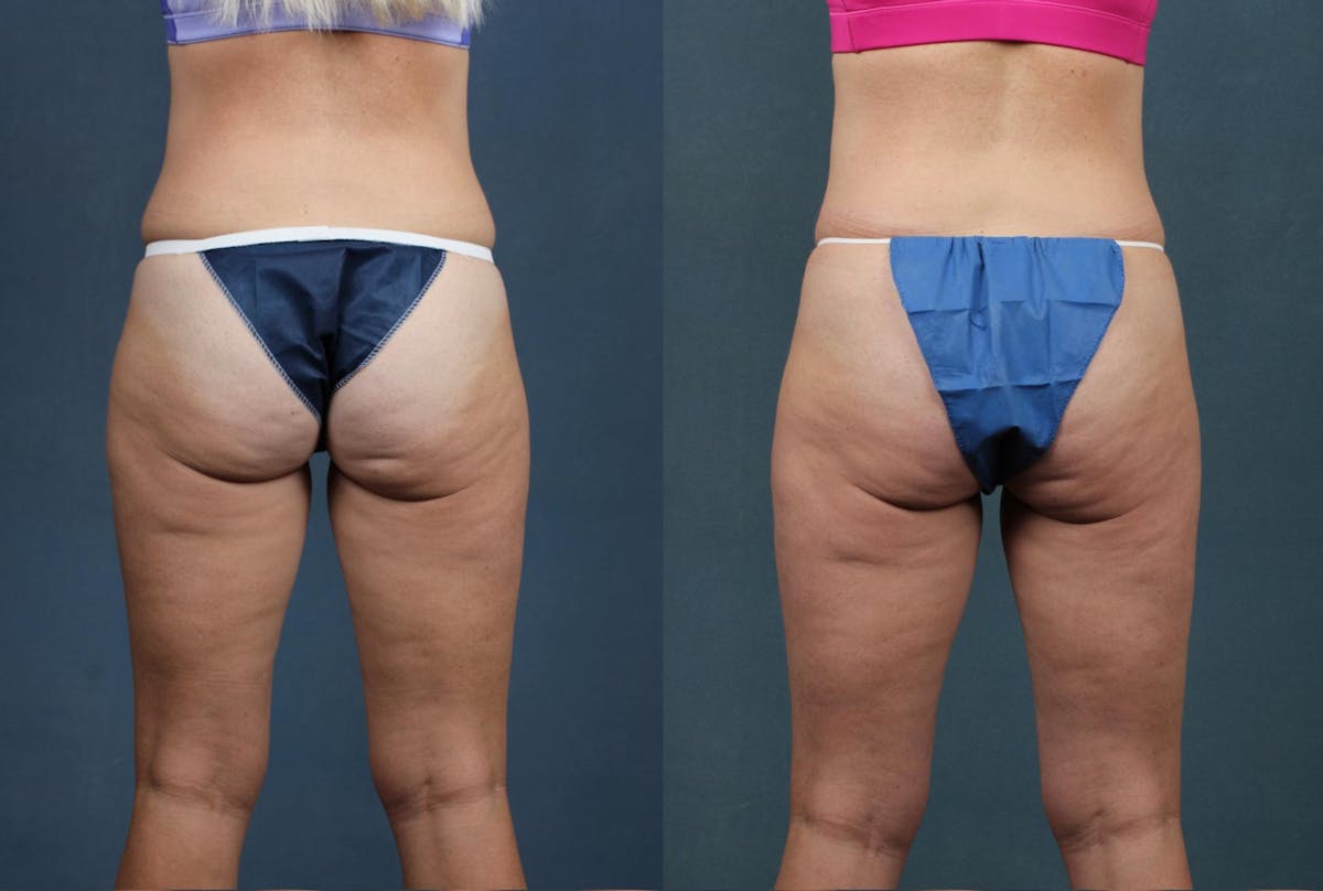 Cellulite Treatments Before & After Gallery - Patient 427951 - Image 1