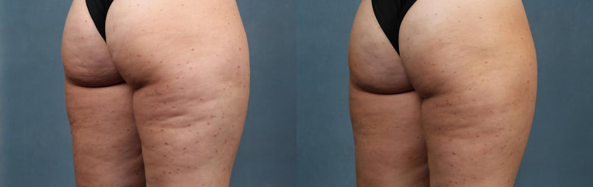 Cellulite Treatments Before & After Gallery - Patient 804236 - Image 1