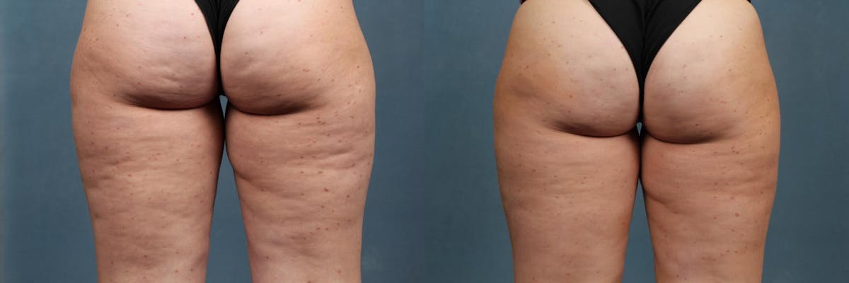 Cellulite Treatments Before & After Gallery - Patient 423381 - Image 1