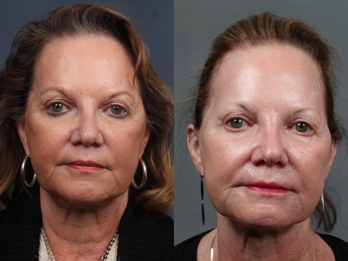 Excel V Laser Treatment Before & After Gallery - Patient 272985 - Image 1