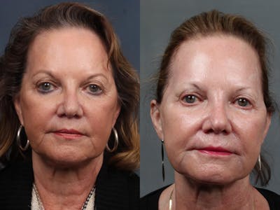 Excel V Laser Treatment Before & After Gallery - Patient 272985 - Image 1