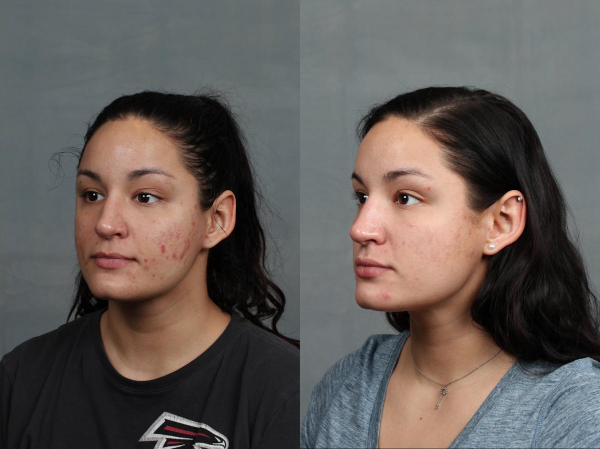 Excel V Laser Treatment Before & After Gallery - Patient 406233 - Image 1