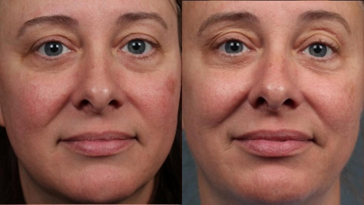 Excel V Laser Treatment Before & After Gallery - Patient 221995 - Image 1
