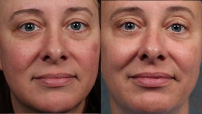 Excel V Laser Treatment Before & After Gallery - Patient 221995 - Image 1