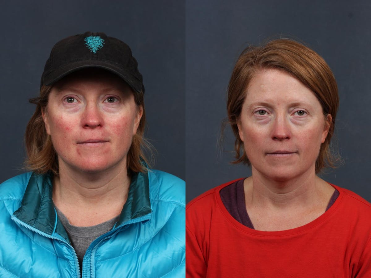 Excel V Laser Treatment Before & After Gallery - Patient 432821 - Image 1