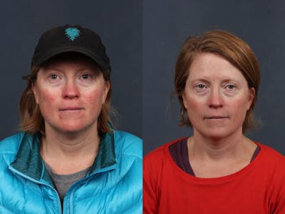 Excel V Laser Treatment Before & After Gallery - Patient 432821 - Image 1