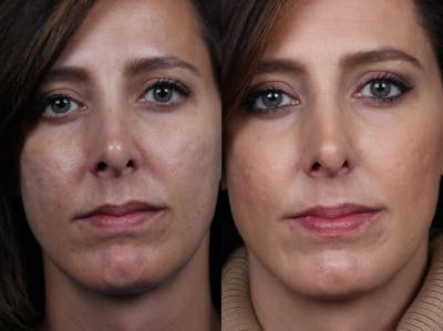 INFINI Before & After Gallery - Patient 104265 - Image 1