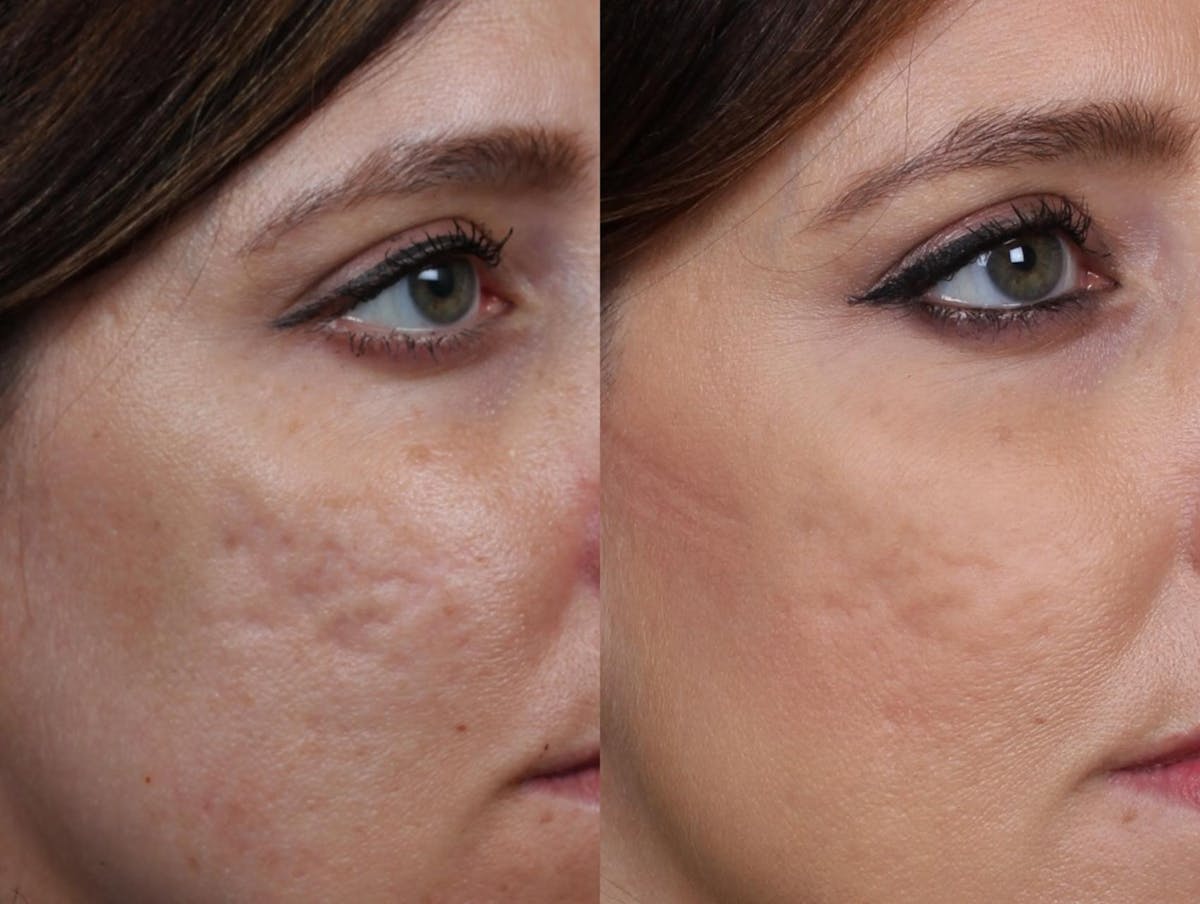 INFINI Before & After Gallery - Patient 104265 - Image 2