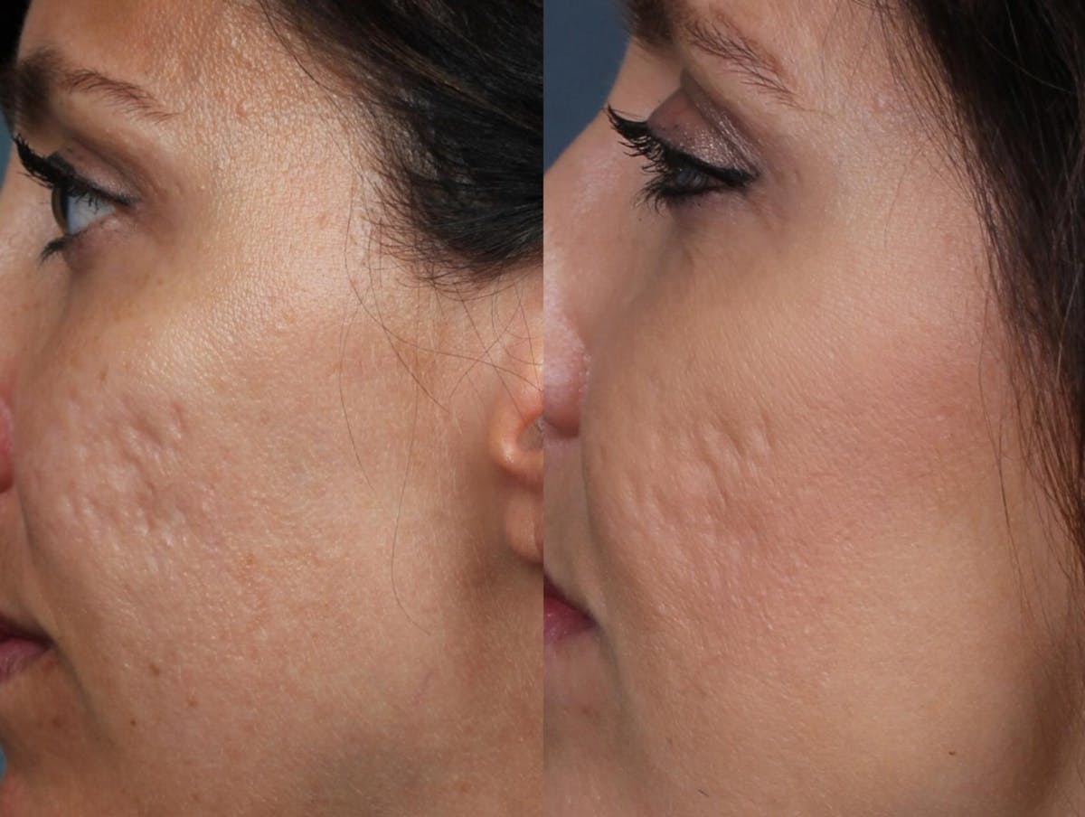 INFINI Before & After Gallery - Patient 104265 - Image 3