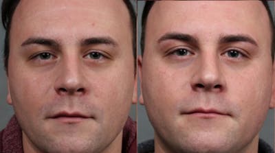 INFINI Before & After Gallery - Patient 193961 - Image 1