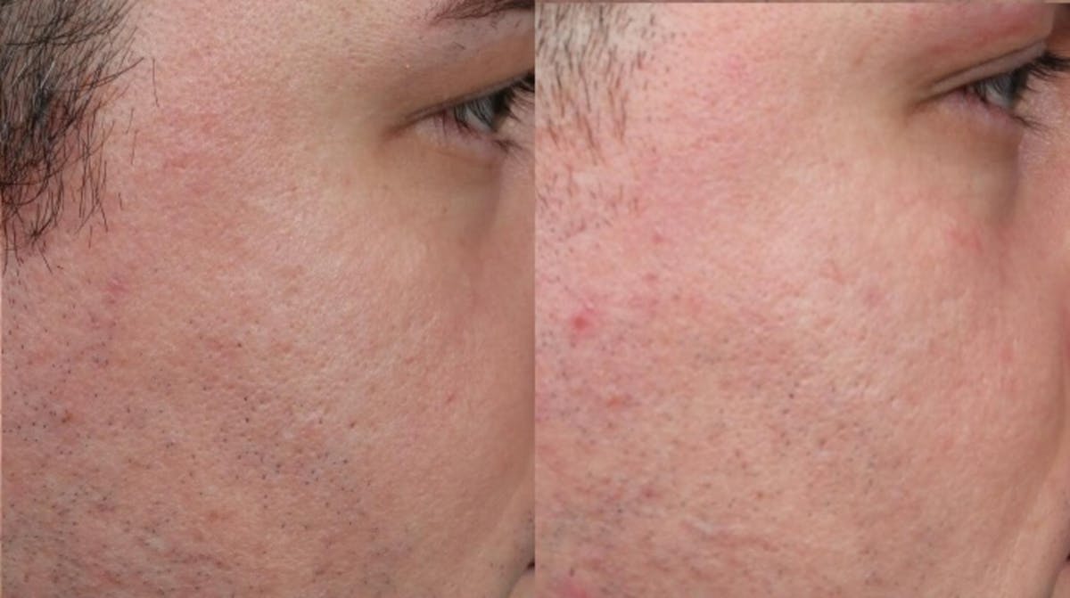 INFINI Before & After Gallery - Patient 193961 - Image 2