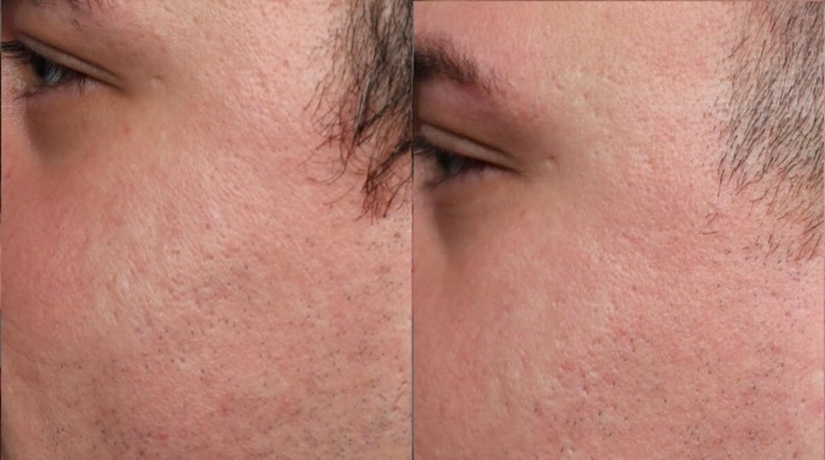 INFINI Before & After Gallery - Patient 193961 - Image 3