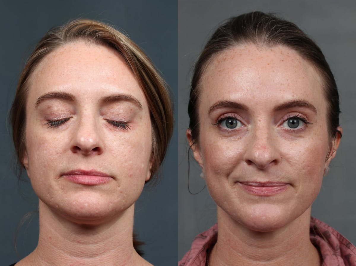 INFINI Before & After Gallery - Patient 176551 - Image 1
