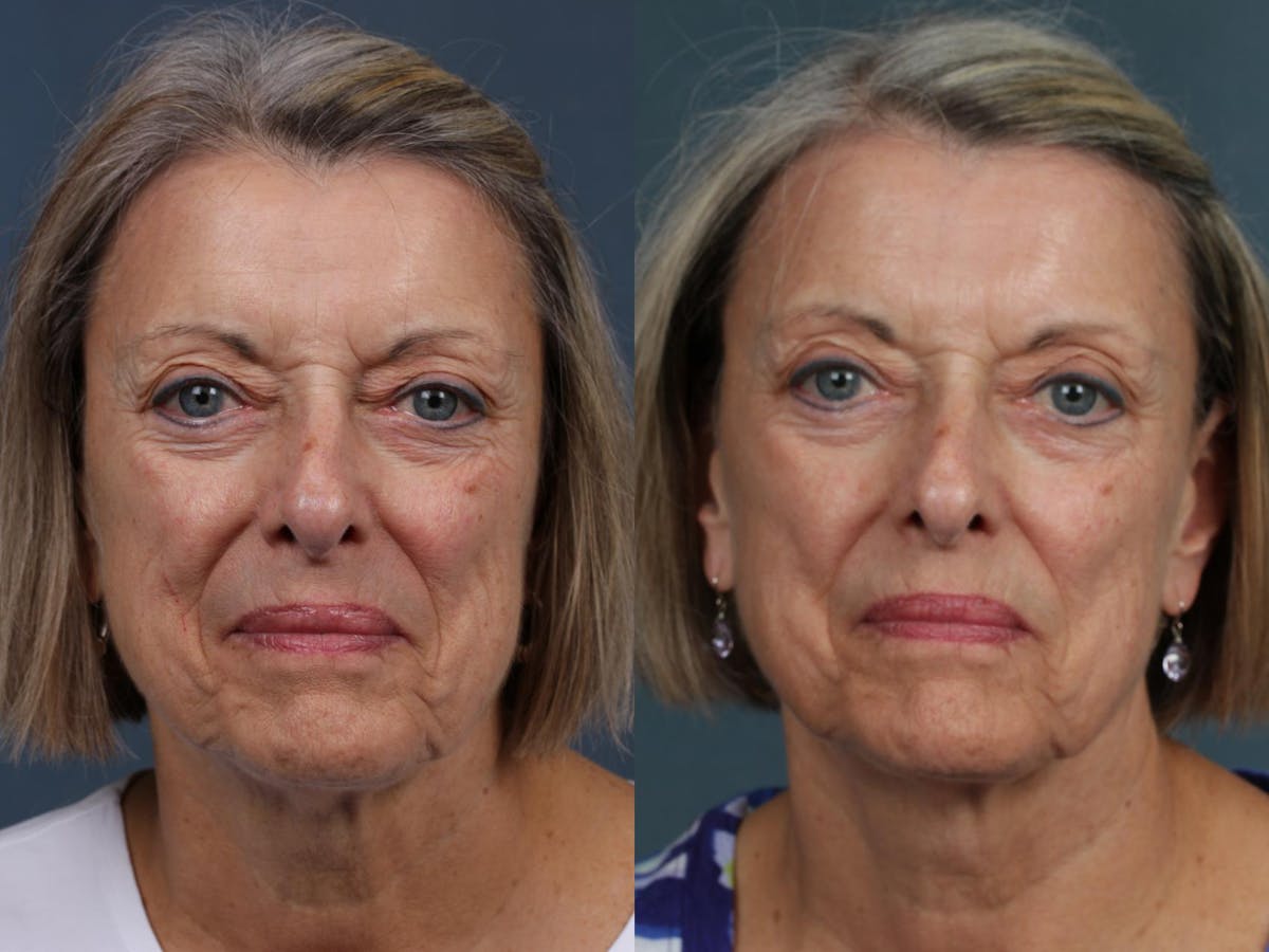 INFINI Before & After Gallery - Patient 249840 - Image 1