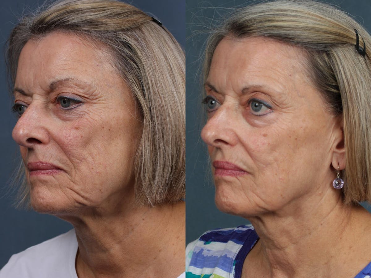 INFINI Before & After Gallery - Patient 249840 - Image 2