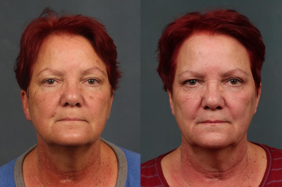 PICO Genesis Laser Treatment Before & After Gallery - Patient 587448 - Image 1