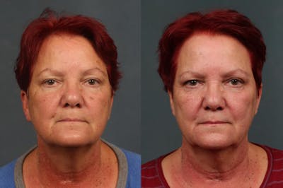 PICO Genesis Laser Treatment Before & After Gallery - Patient 587448 - Image 1