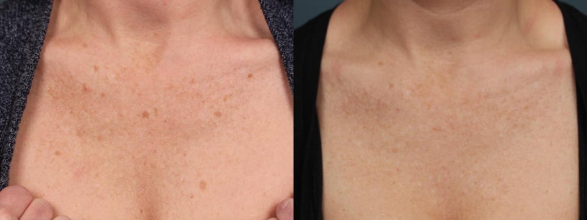 PICO Genesis Laser Treatment Before & After Gallery - Patient 103569 - Image 1