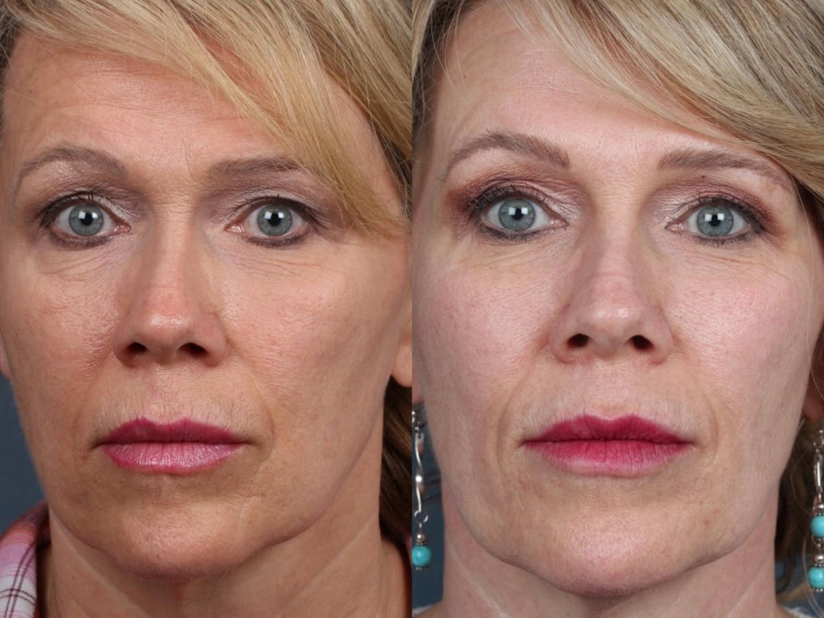 PICO Genesis Laser Treatment Before & After Gallery - Patient 551978 - Image 1