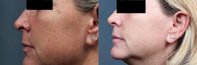 PICO Genesis Laser Treatment Before & After Gallery - Patient 498159 - Image 1