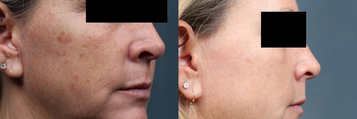 PICO Genesis Laser Treatment Before & After Gallery - Patient 498159 - Image 2