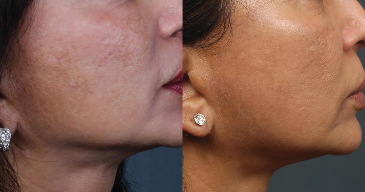 PICO Genesis Laser Treatment Before & After Gallery - Patient 237800 - Image 1