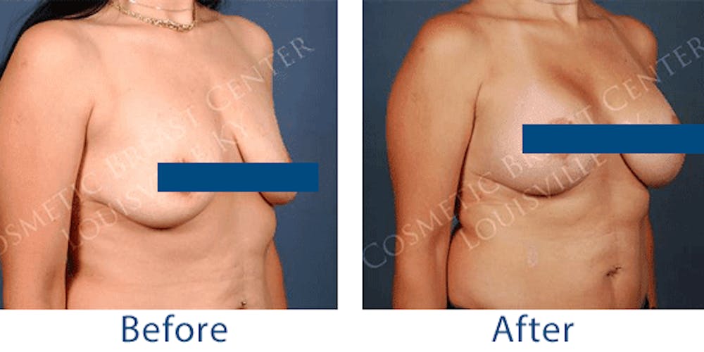 This woman underwent a combined breast augmentation and breast lift to both address sagging tissue and add volume to the breasts in Louisville, KY.