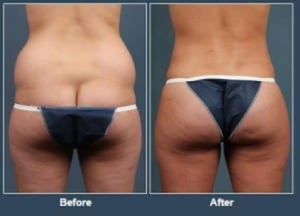 Louisville plastic surgeon discusses liposuction and fat transfer.