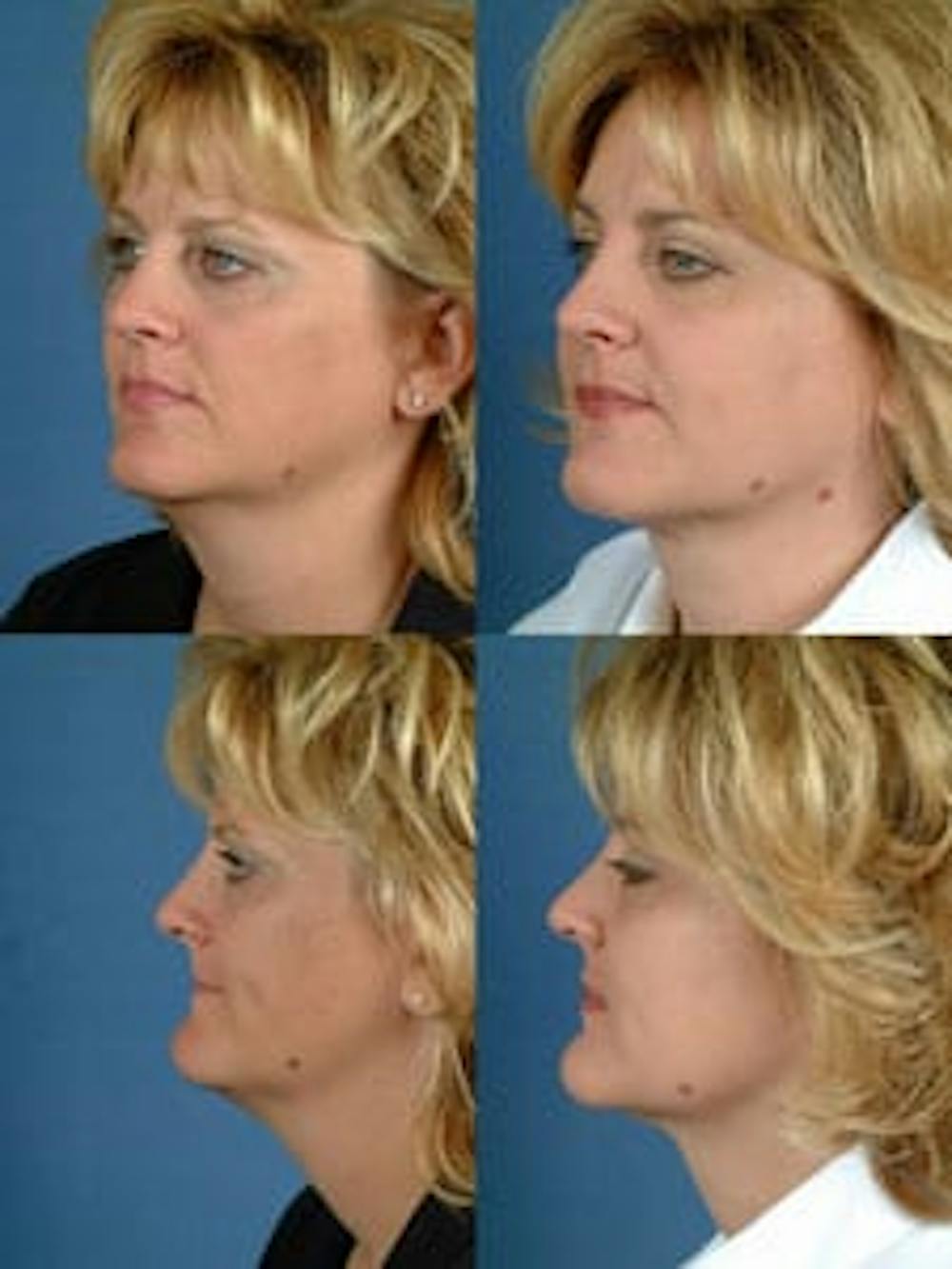 neck lift patient results