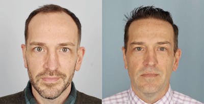 Hair Restoration Before & After Gallery - Patient 994551 - Image 1