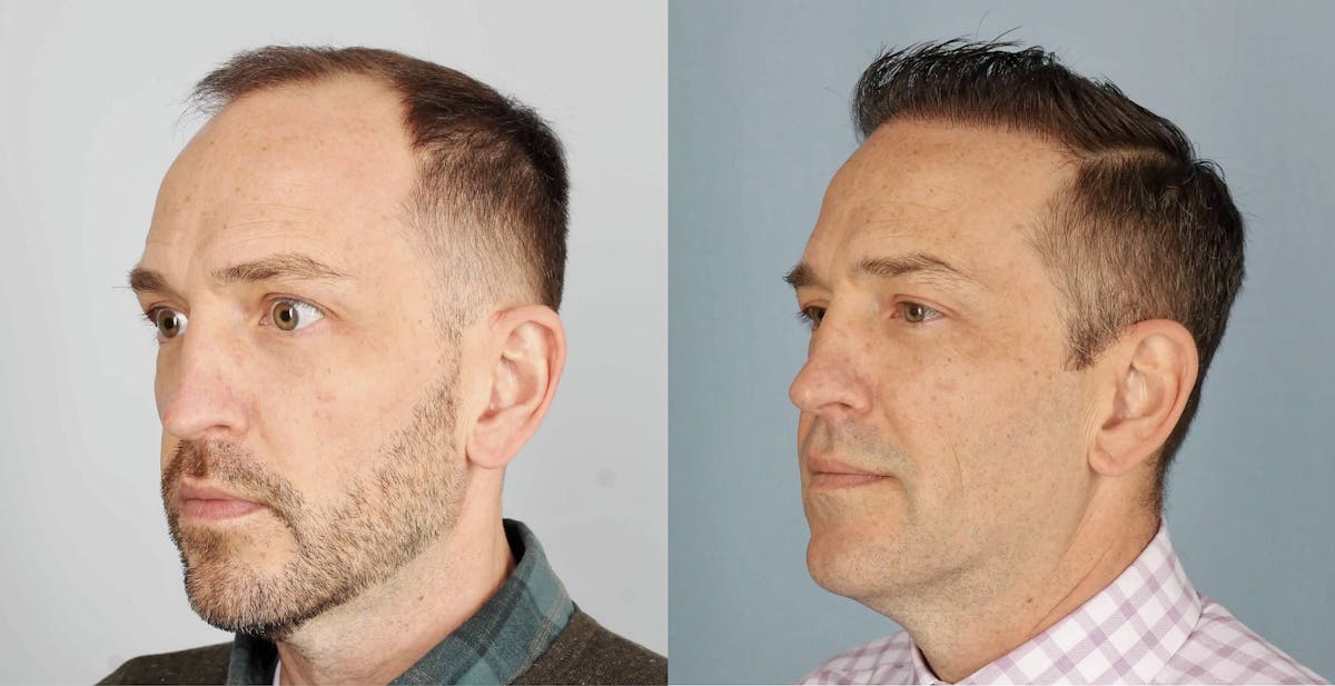 Hair Restoration Before & After Gallery - Patient 994551 - Image 3