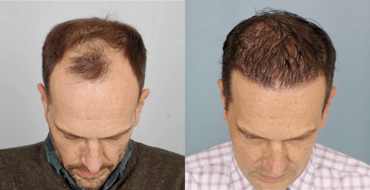 Hair Restoration Before & After Gallery - Patient 994551 - Image 2