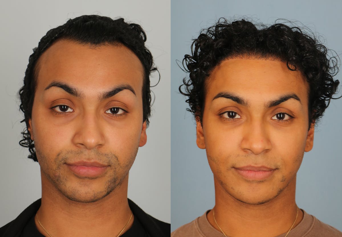 Hair Restoration Before & After Gallery - Patient 424452 - Image 1