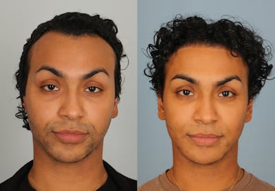 Hair Restoration Before & After Gallery - Patient 424452 - Image 1