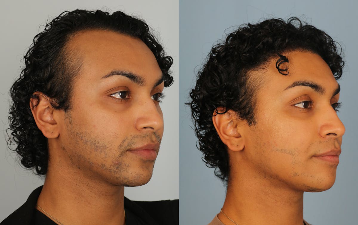 Hair Restoration Before & After Gallery - Patient 424452 - Image 3
