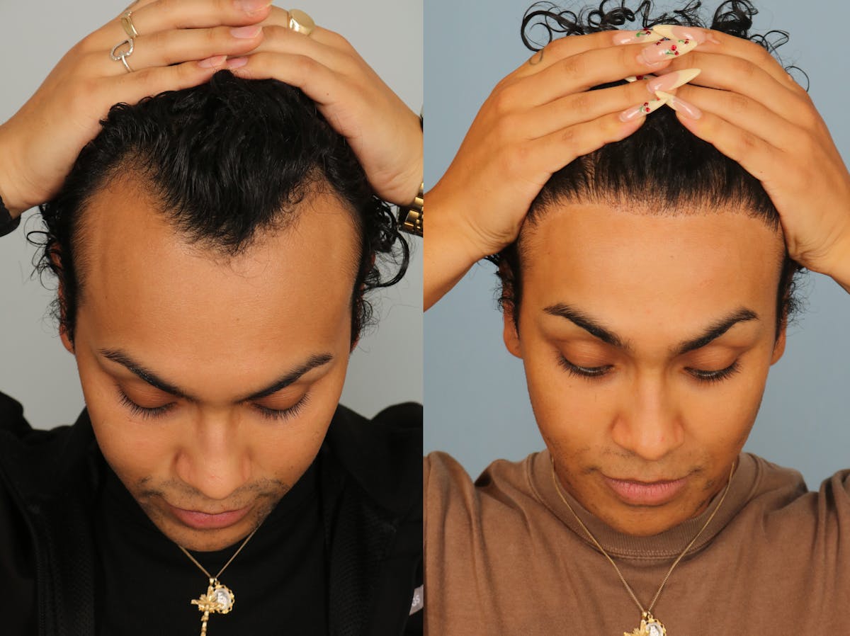 Hair Restoration Before & After Gallery - Patient 424452 - Image 2