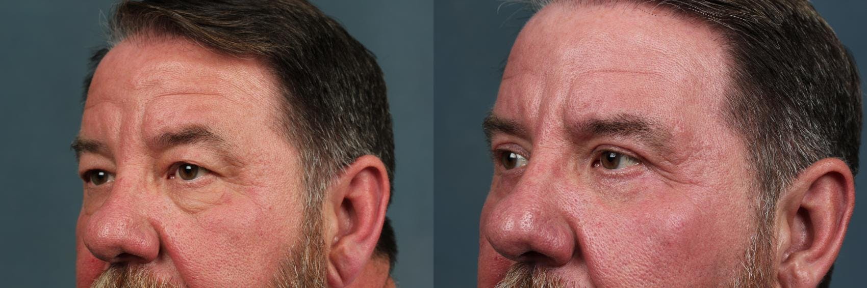 Eyelid Surgery Before & After Gallery - Patient 297805 - Image 2