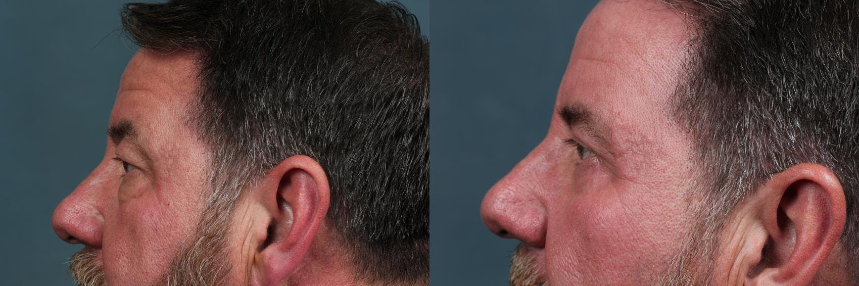 Eyelid Surgery Before & After Gallery - Patient 297805 - Image 3