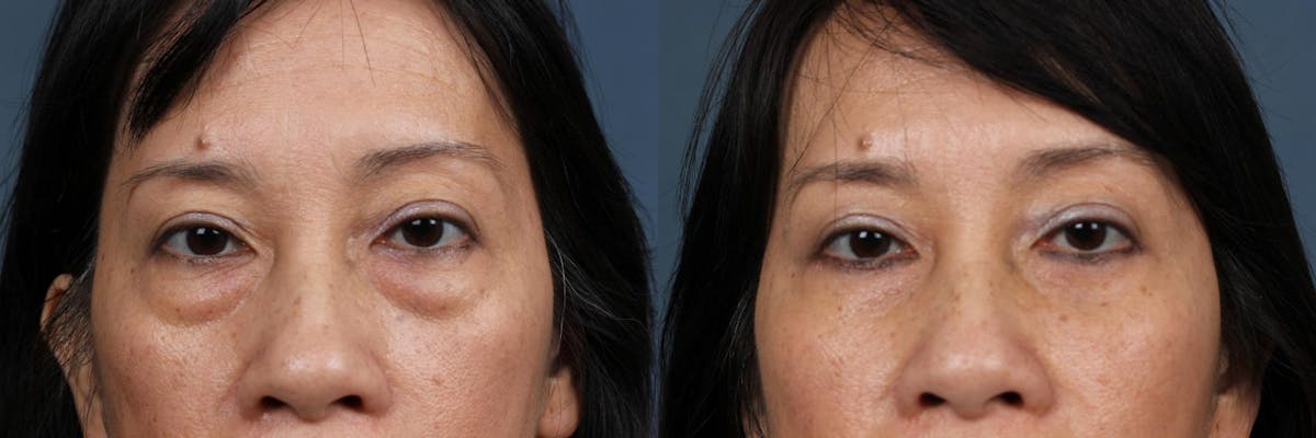 Eyelid Surgery Before & After Gallery - Patient 632379 - Image 1