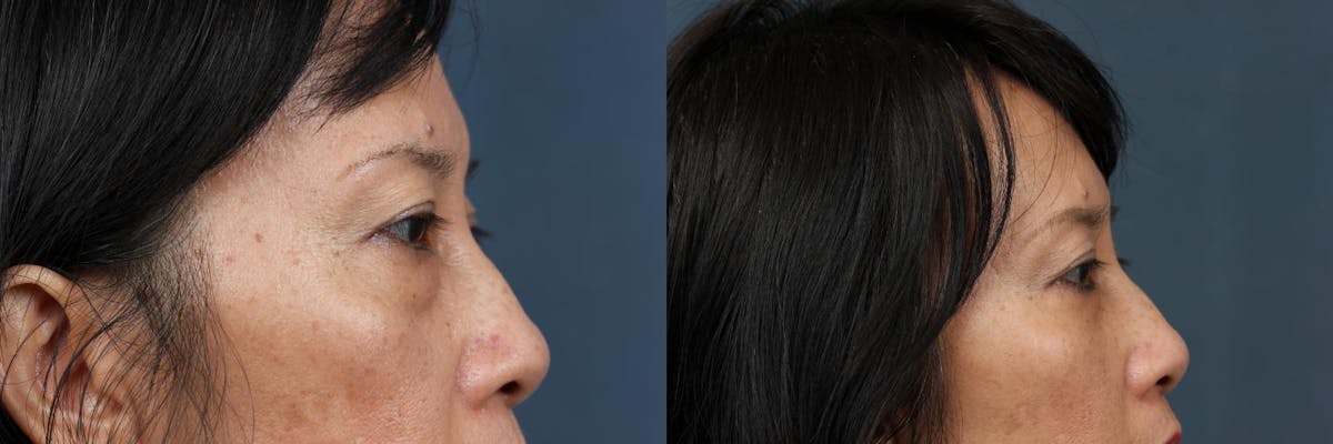 Eyelid Surgery Before & After Gallery - Patient 632379 - Image 3